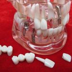 Transparent Pathological Adult Removable Tooth Teaching Model